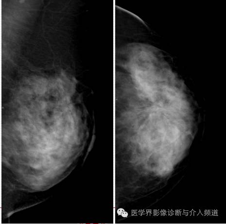 乳腺增生X线分类,你掌握了吗? 乳腺增生X线分类,你掌握了吗?