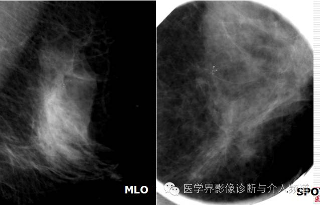 乳腺增生X线分类,你掌握了吗? 乳腺增生X线分类,你掌握了吗?