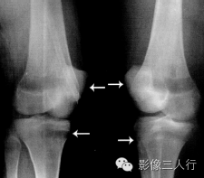 "干骺端透亮带"，这个征象提示啥？