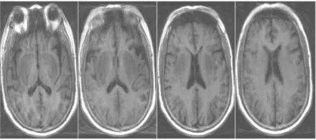 【病例】尿毒症脑病1例CT及MR读片