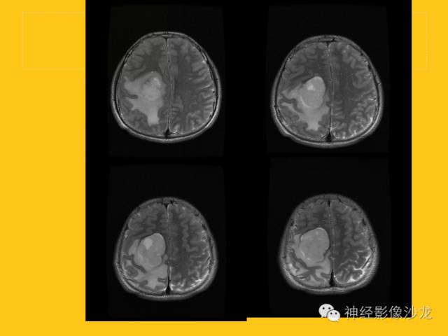 【病例】幕上毛细胞型星形细胞瘤1例MR影像表现