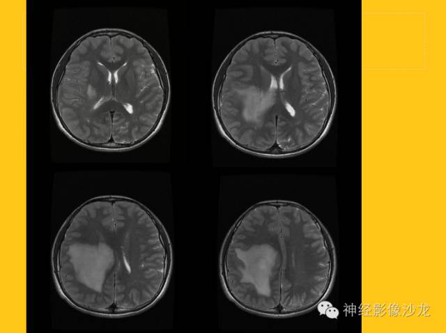 【病例】幕上毛细胞型星形细胞瘤1例MR影像表现