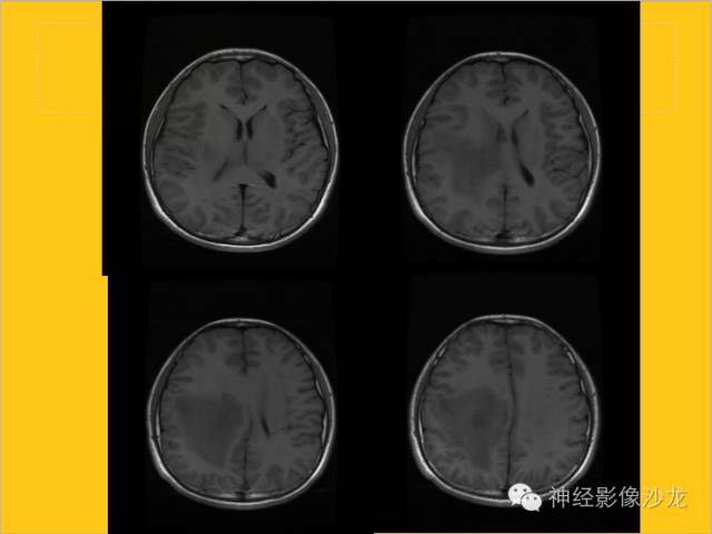 【病例】幕上毛细胞型星形细胞瘤1例MR影像表现