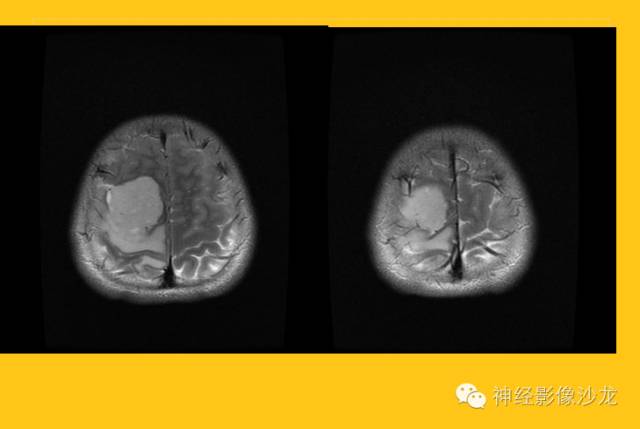 【病例】幕上毛细胞型星形细胞瘤1例MR影像表现