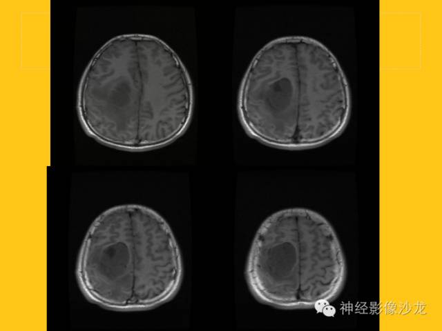 【病例】幕上毛细胞型星形细胞瘤1例MR影像表现