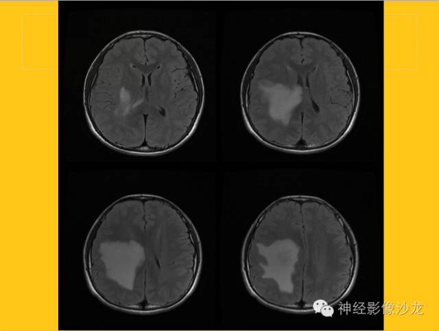 【病例】幕上毛细胞型星形细胞瘤1例MR影像表现
