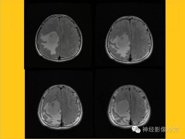 【病例】幕上毛细胞型星形细胞瘤1例MR影像表现