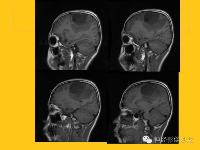 【病例】幕上毛细胞型星形细胞瘤1例MR影像表现