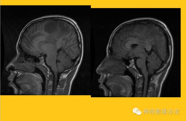 【病例】幕上毛细胞型星形细胞瘤1例MR影像表现