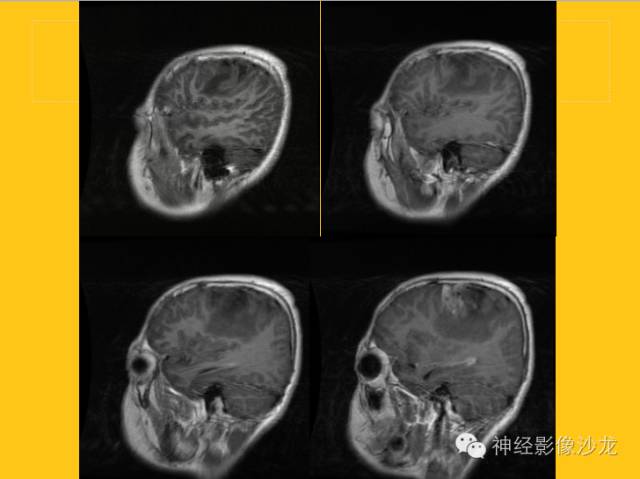 【病例】幕上毛细胞型星形细胞瘤1例MR影像表现