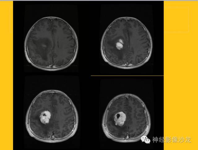 【病例】幕上毛细胞型星形细胞瘤1例MR影像表现