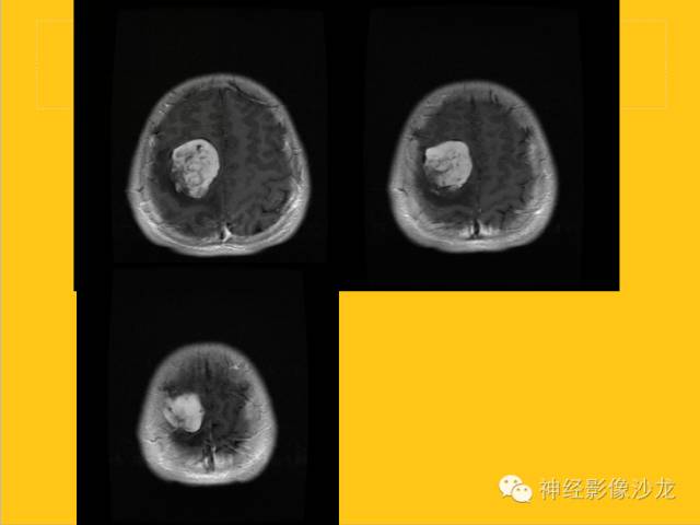 【病例】幕上毛细胞型星形细胞瘤1例MR影像表现