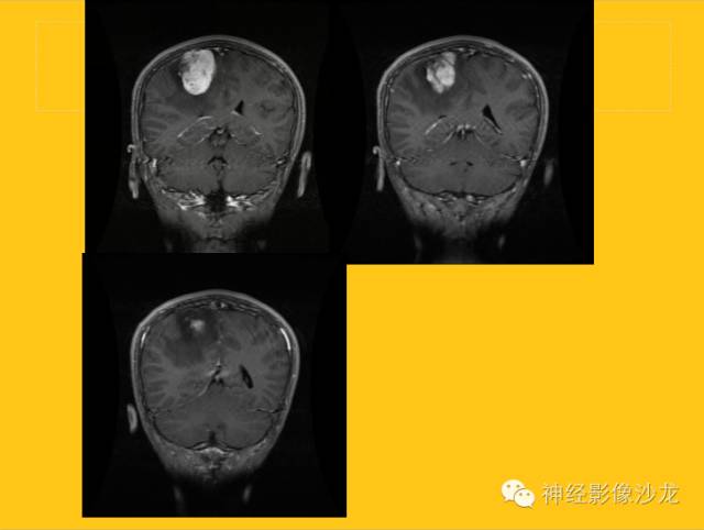 【病例】幕上毛细胞型星形细胞瘤1例MR影像表现