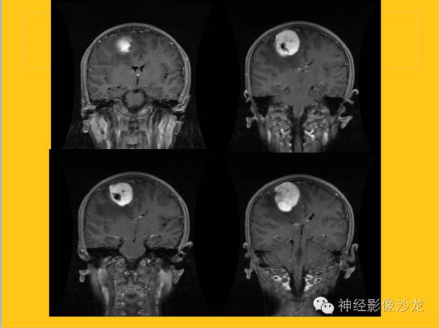 【病例】幕上毛细胞型星形细胞瘤1例MR影像表现