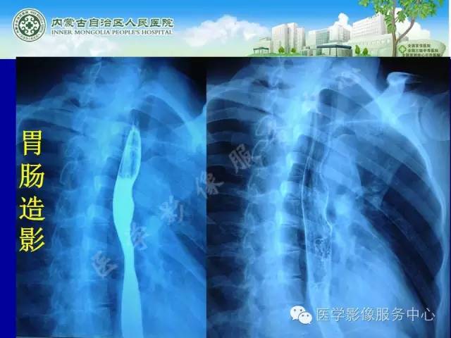 【病例】深在性囊性胃炎1例CT影像表现 【病例】深在性囊性胃炎1例CT影像表现