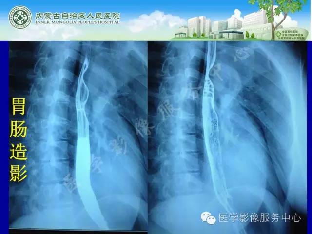 【病例】深在性囊性胃炎1例CT影像表现 【病例】深在性囊性胃炎1例CT影像表现