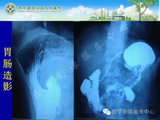 【病例】深在性囊性胃炎1例CT影像表现 【病例】深在性囊性胃炎1例CT影像表现