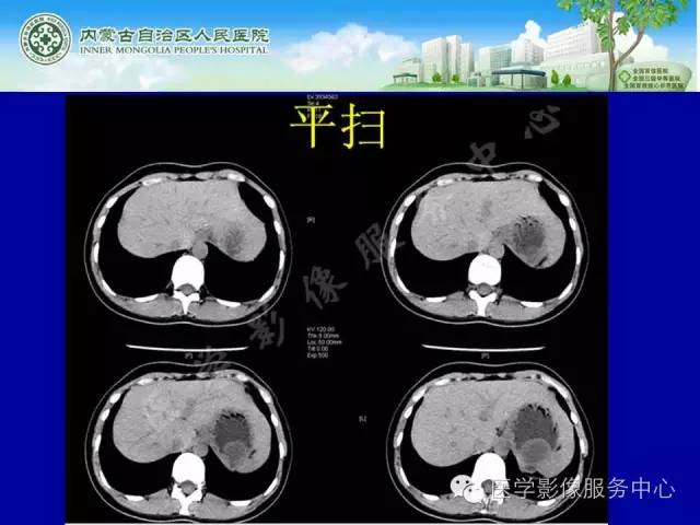 【病例】深在性囊性胃炎1例CT影像表现 【病例】深在性囊性胃炎1例CT影像表现