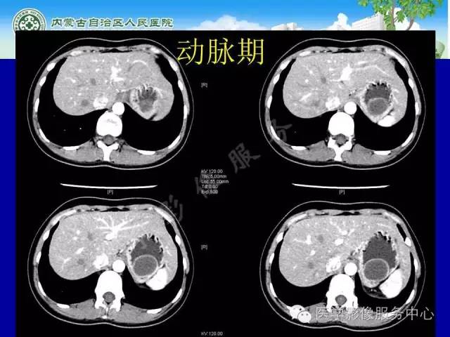 【病例】深在性囊性胃炎1例CT影像表现 【病例】深在性囊性胃炎1例CT影像表现