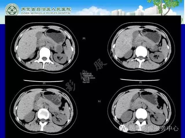 【病例】深在性囊性胃炎1例CT影像表现 【病例】深在性囊性胃炎1例CT影像表现
