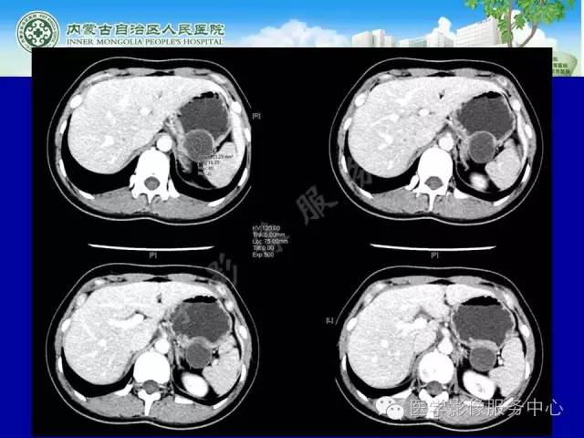 【病例】深在性囊性胃炎1例CT影像表现 【病例】深在性囊性胃炎1例CT影像表现