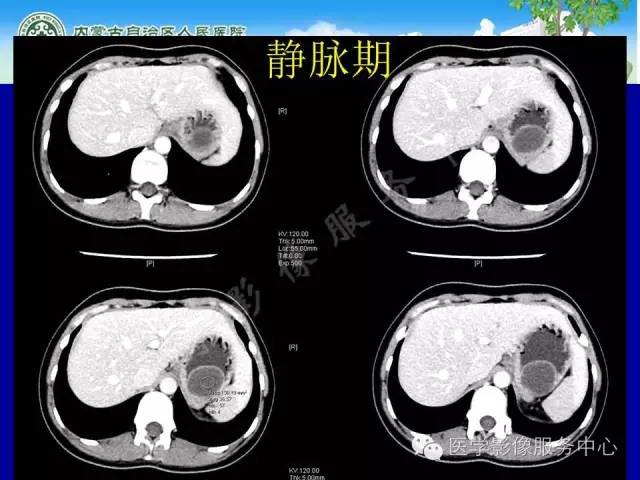 【病例】深在性囊性胃炎1例CT影像表现 【病例】深在性囊性胃炎1例CT影像表现