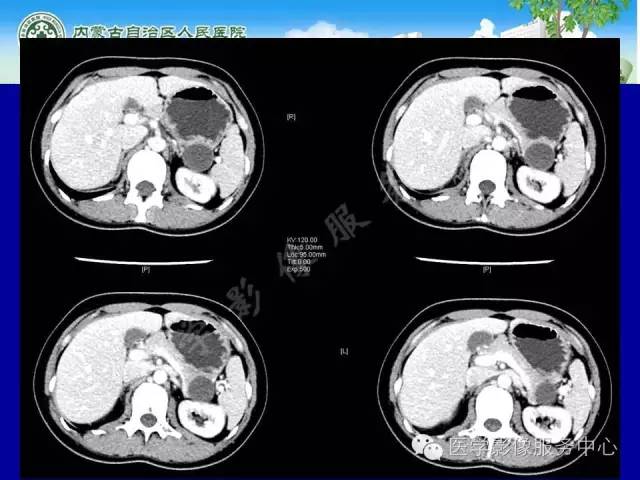 【病例】深在性囊性胃炎1例CT影像表现 【病例】深在性囊性胃炎1例CT影像表现