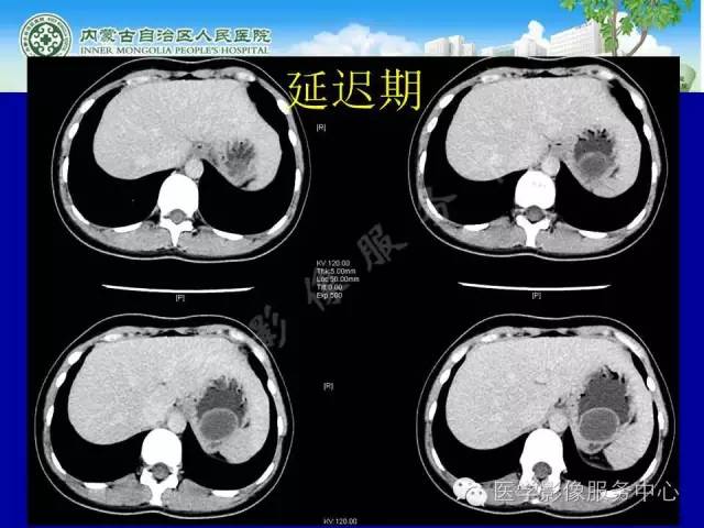 【病例】深在性囊性胃炎1例CT影像表现 【病例】深在性囊性胃炎1例CT影像表现