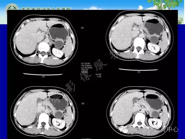 【病例】深在性囊性胃炎1例CT影像表现 【病例】深在性囊性胃炎1例CT影像表现