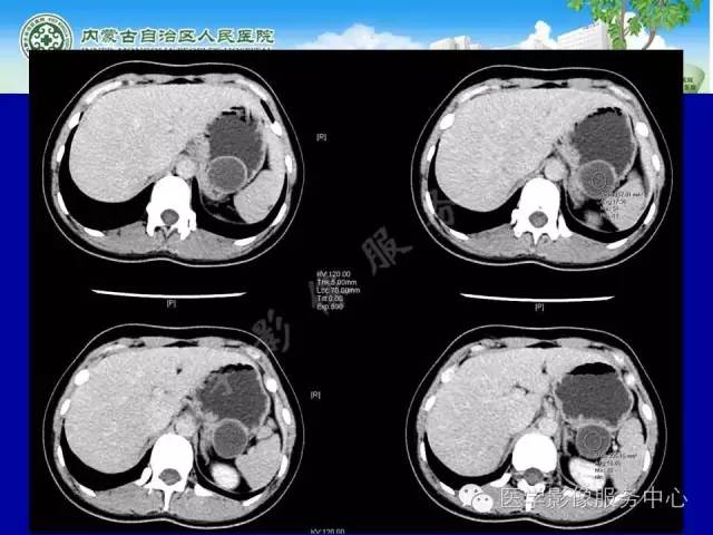 【病例】深在性囊性胃炎1例CT影像表现 【病例】深在性囊性胃炎1例CT影像表现