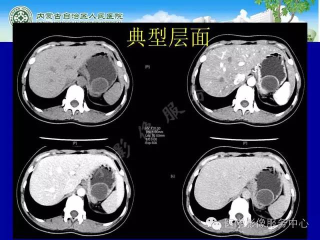 【病例】深在性囊性胃炎1例CT影像表现 【病例】深在性囊性胃炎1例CT影像表现