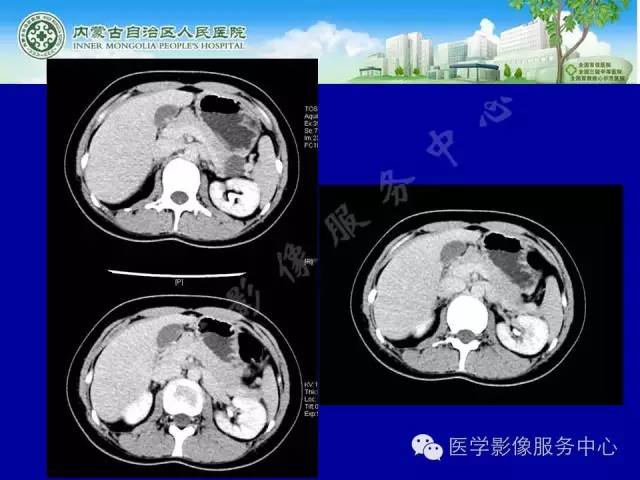 【病例】深在性囊性胃炎1例CT影像表现 【病例】深在性囊性胃炎1例CT影像表现