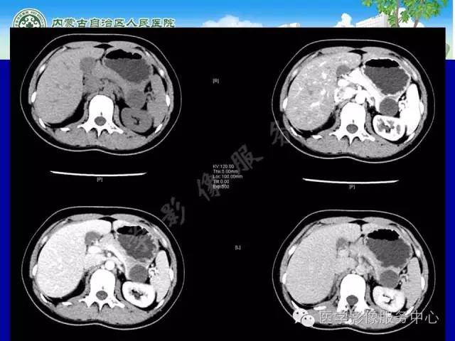 【病例】深在性囊性胃炎1例CT影像表现 【病例】深在性囊性胃炎1例CT影像表现