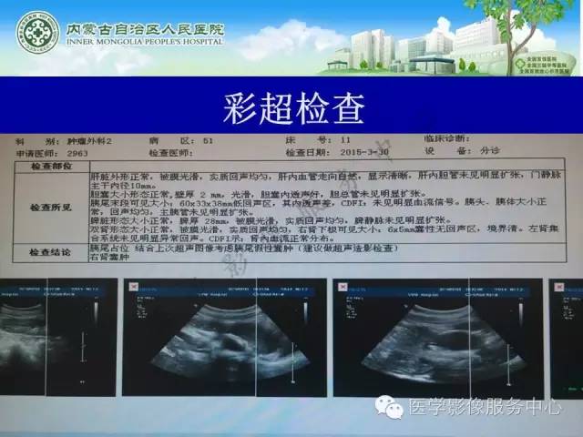 【病例】深在性囊性胃炎1例CT影像表现 【病例】深在性囊性胃炎1例CT影像表现