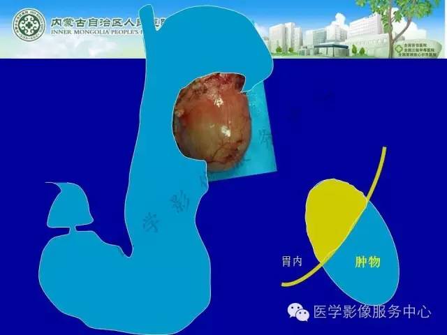 【病例】深在性囊性胃炎1例CT影像表现 【病例】深在性囊性胃炎1例CT影像表现