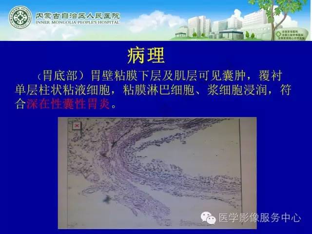 【病例】深在性囊性胃炎1例CT影像表现 【病例】深在性囊性胃炎1例CT影像表现