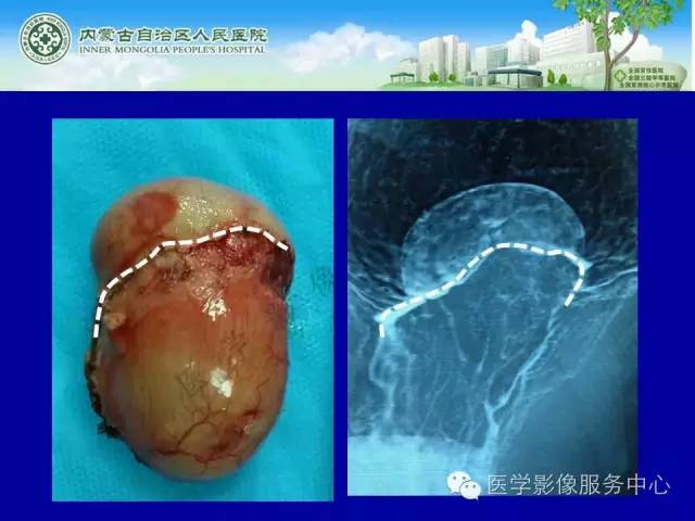 【病例】深在性囊性胃炎1例CT影像表现 【病例】深在性囊性胃炎1例CT影像表现