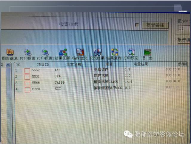 【病例】胰头神经内分泌肿瘤1例CT影像表现 【病例】胰头神经内分泌肿瘤1例CT影像表现
