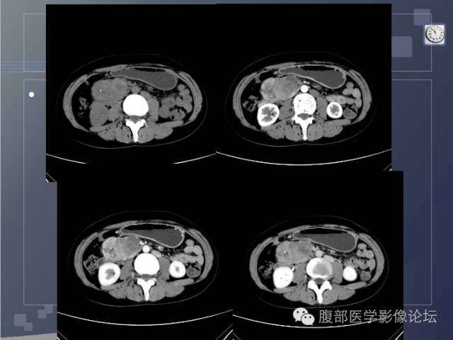 【病例】胰头神经内分泌肿瘤1例CT影像表现 【病例】胰头神经内分泌肿瘤1例CT影像表现
