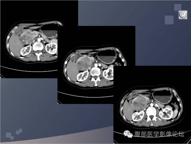 【病例】胰头神经内分泌肿瘤1例CT影像表现 【病例】胰头神经内分泌肿瘤1例CT影像表现