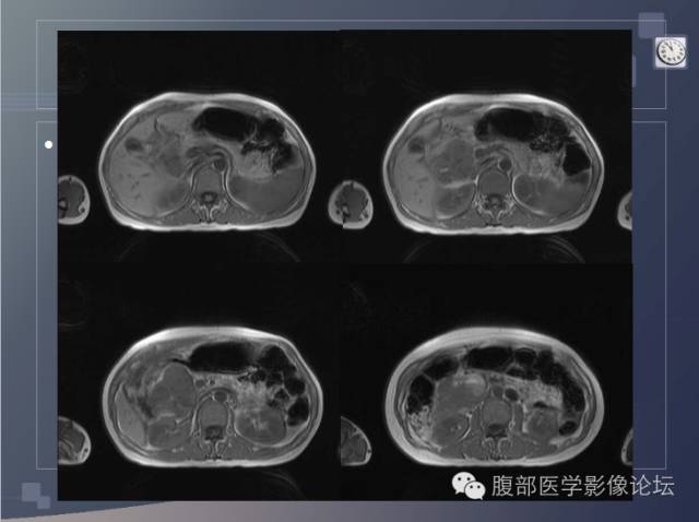 【病例】胰头神经内分泌肿瘤1例CT影像表现 【病例】胰头神经内分泌肿瘤1例CT影像表现