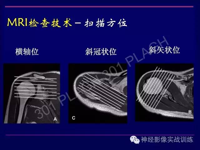 【PPT】肩关节撞击综合征的磁共振诊断