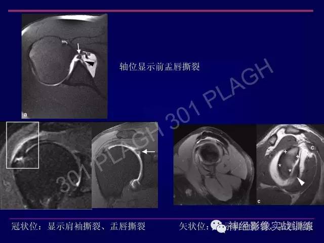 【PPT】肩关节撞击综合征的磁共振诊断