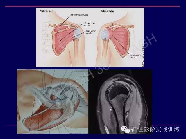 【PPT】肩关节撞击综合征的磁共振诊断