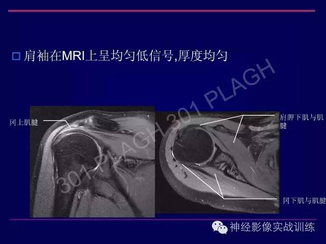 【PPT】肩关节撞击综合征的磁共振诊断