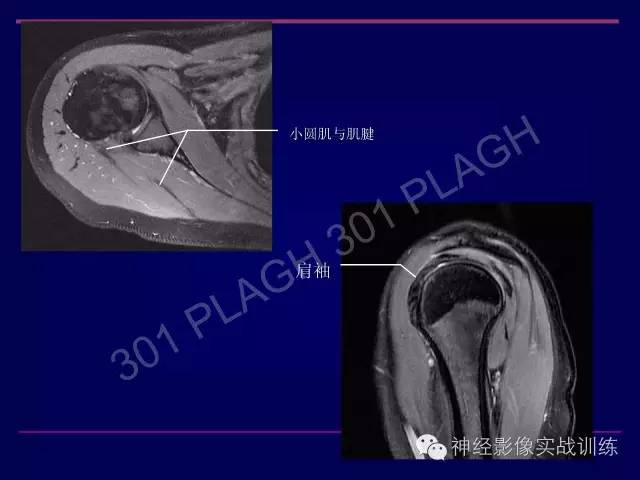【PPT】肩关节撞击综合征的磁共振诊断