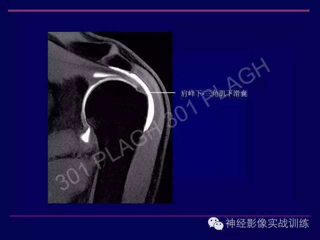 【PPT】肩关节撞击综合征的磁共振诊断