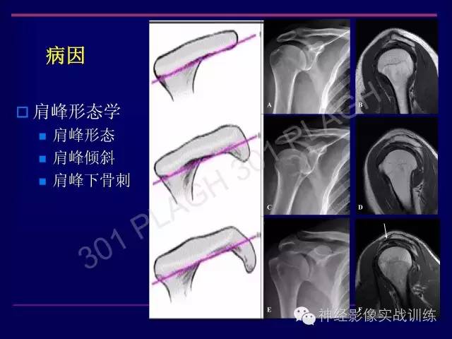 【PPT】肩关节撞击综合征的磁共振诊断
