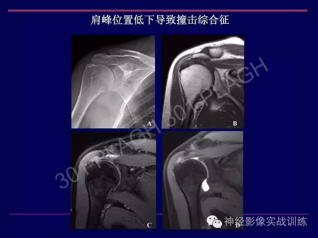 【PPT】肩关节撞击综合征的磁共振诊断