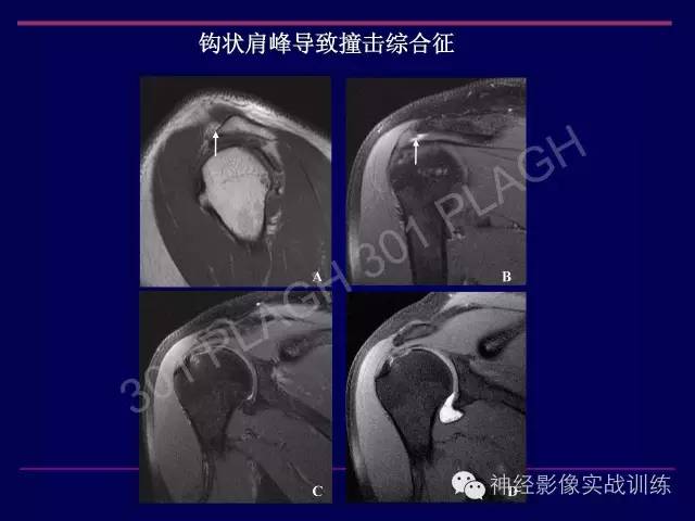【PPT】肩关节撞击综合征的磁共振诊断